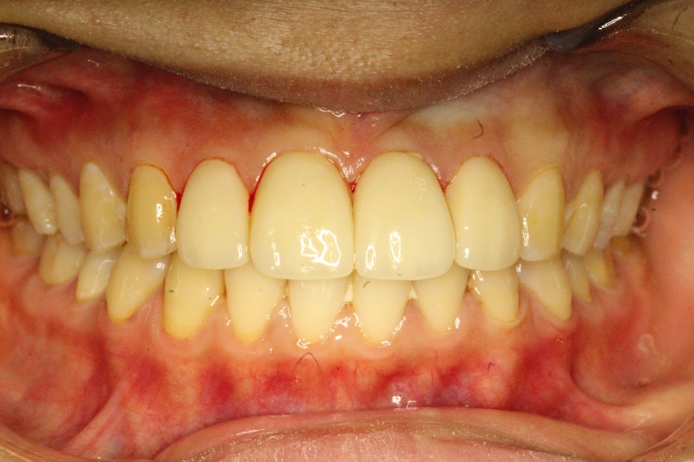 veneer after